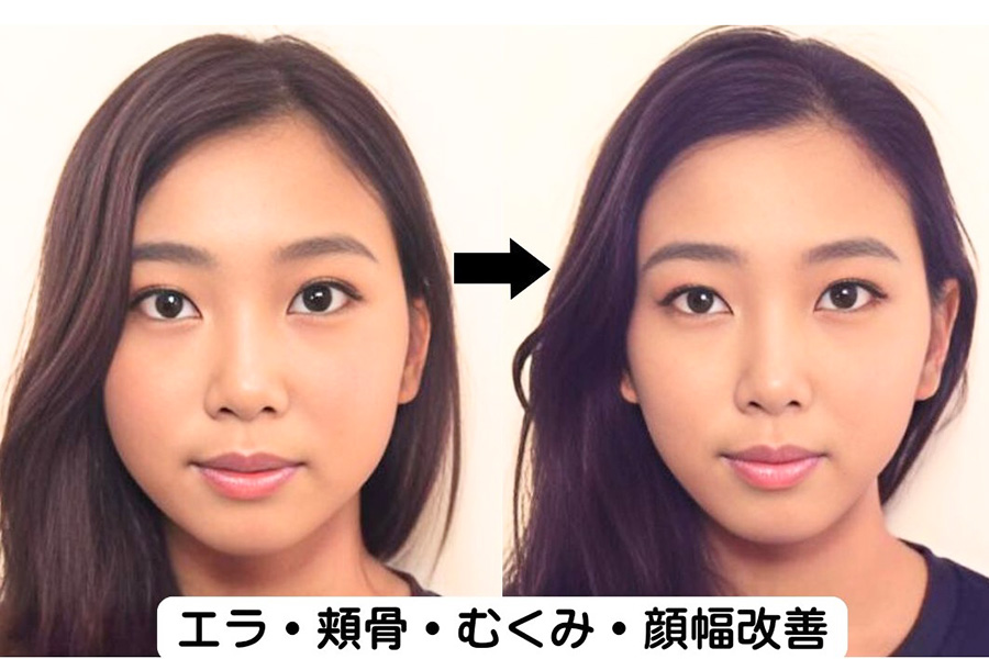 エラ・頬骨・むくみ・顔幅改善