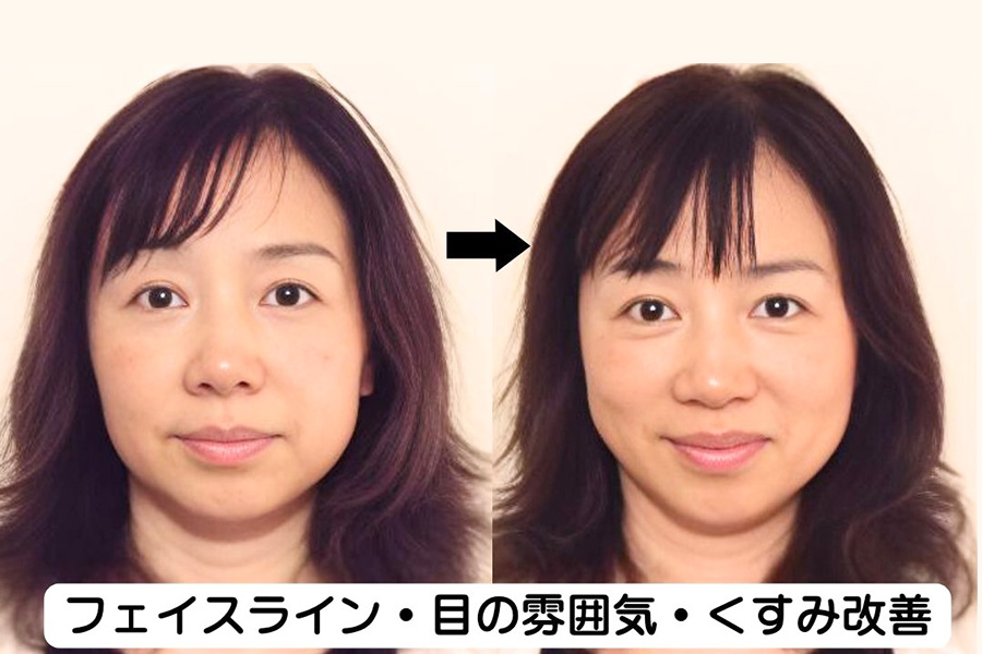 フェイスライン・目の雰囲気・くすみ改善