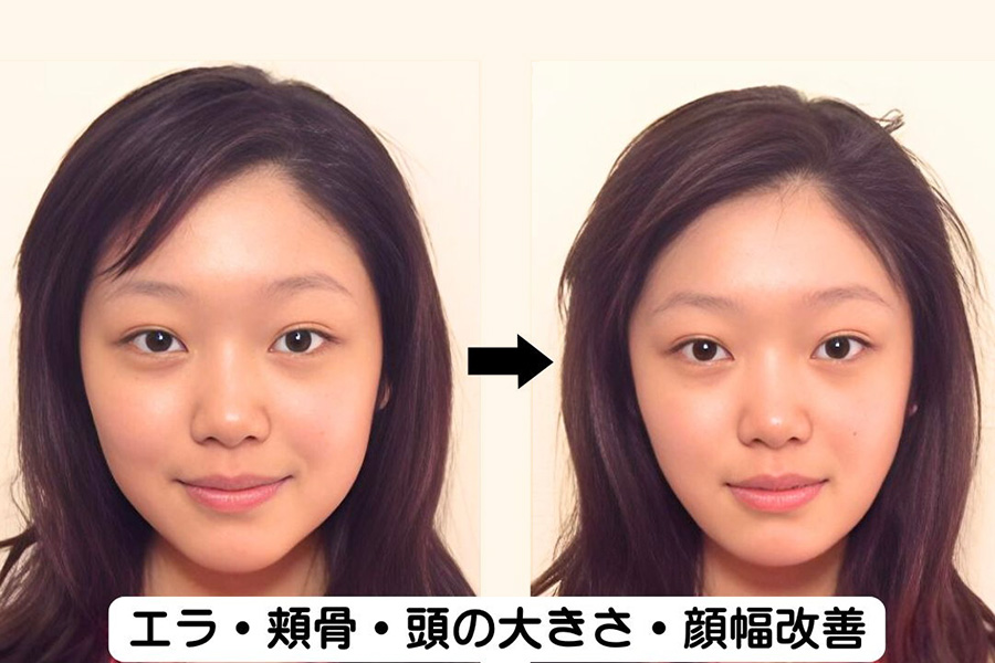 エラ・頬骨・頭の大きさ・顔幅改善