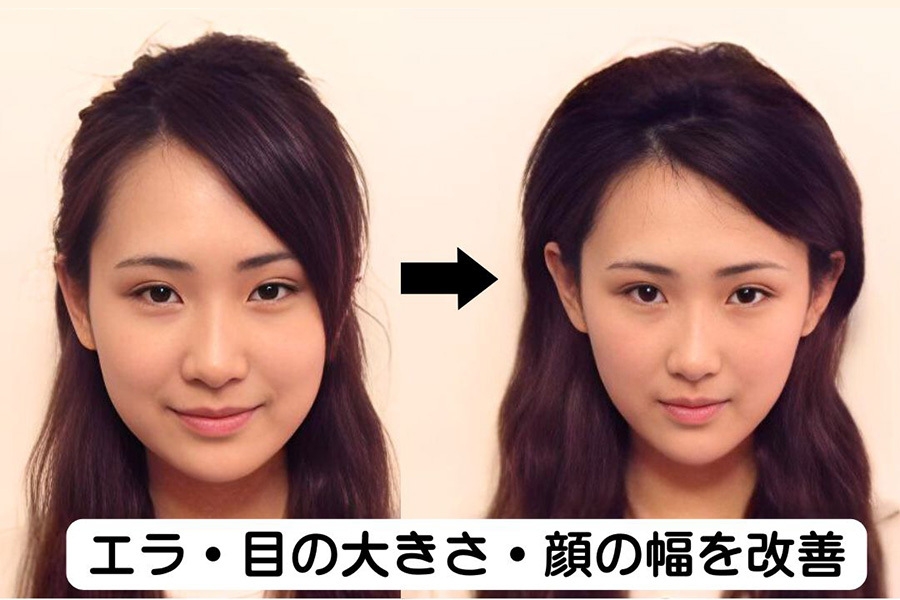エラ・目の大きさ・顔の幅を改善