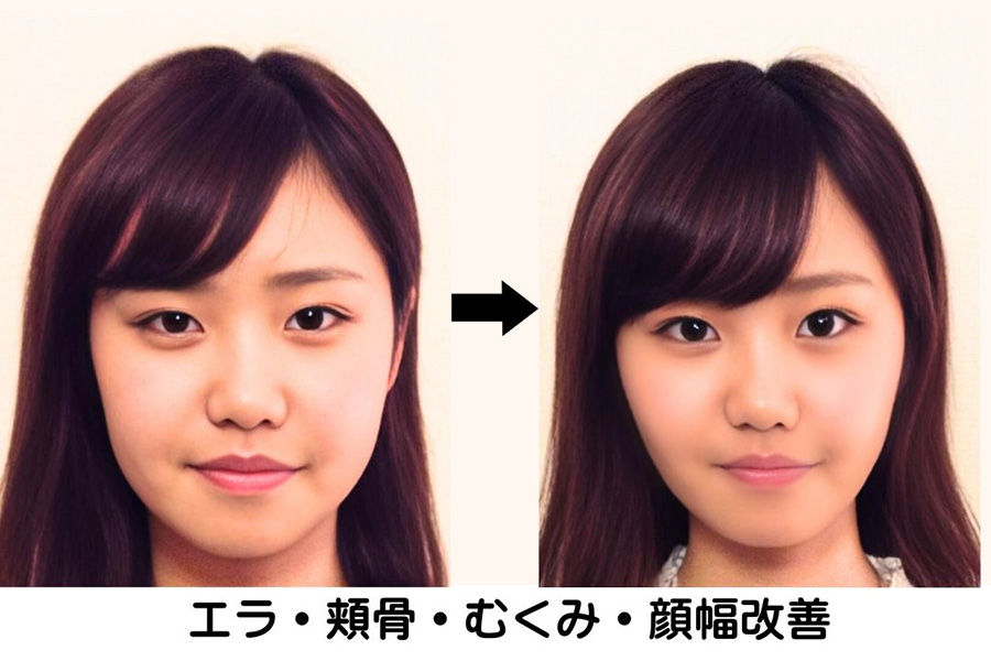 エラ・頬骨・むくみ・顔幅改善